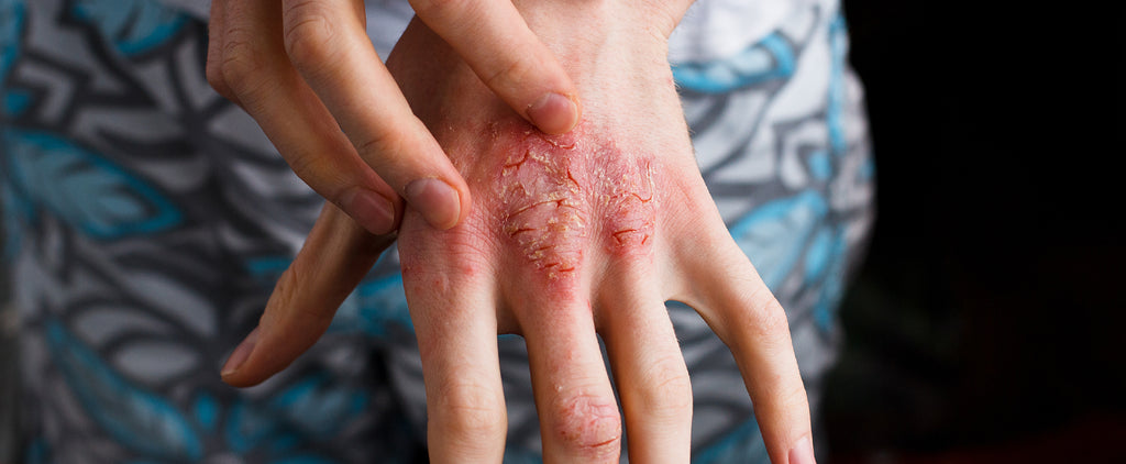 Top 3 Ways Omega-3 Supplementation Can Help with Eczema